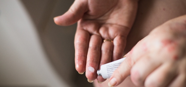 person squeezing ointment from a bottle