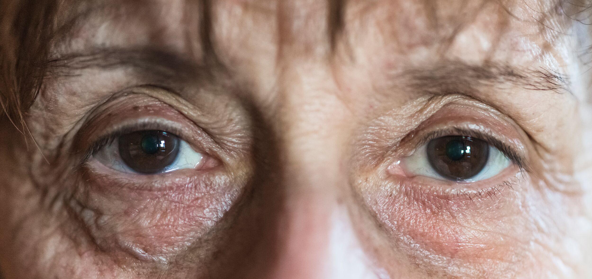 close up of someone's eyes, which may be affected in MS and NMOSD